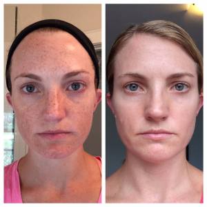 REVERSE Lightening Accelerator Before and After